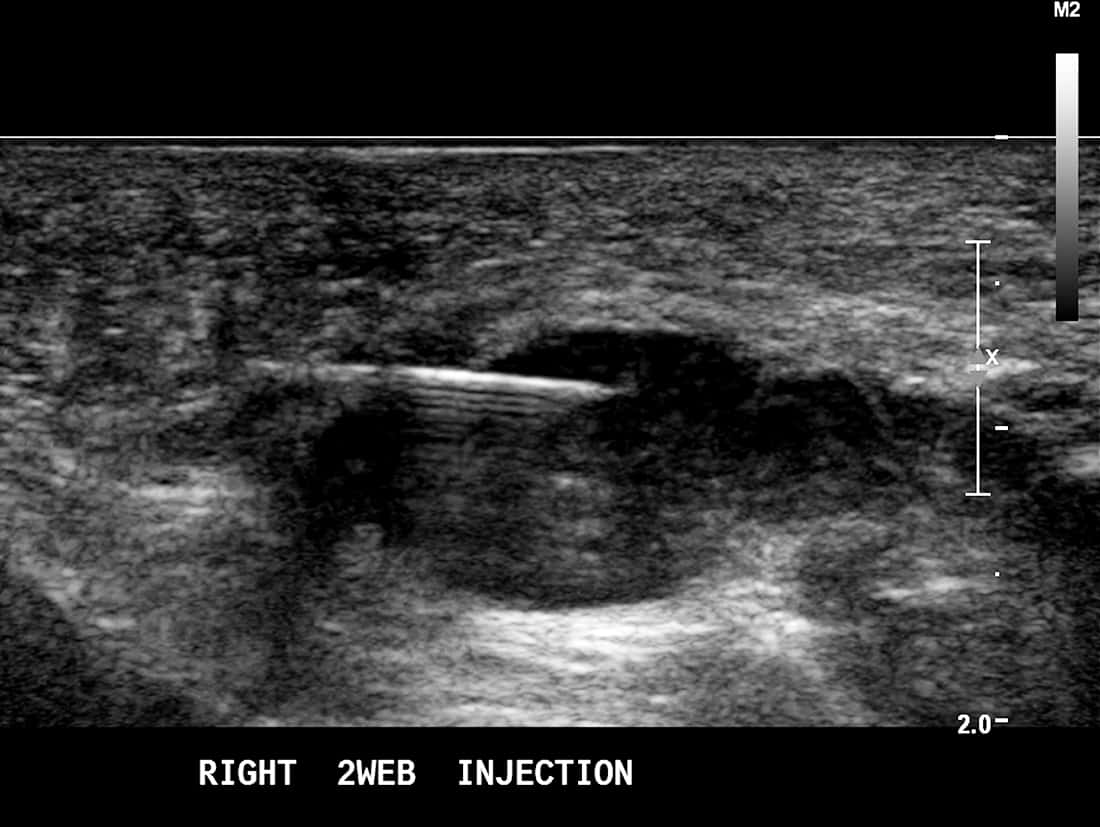Ultrasound Guided RFA Mortons Neuroma - Melbourne Radiology Clinic