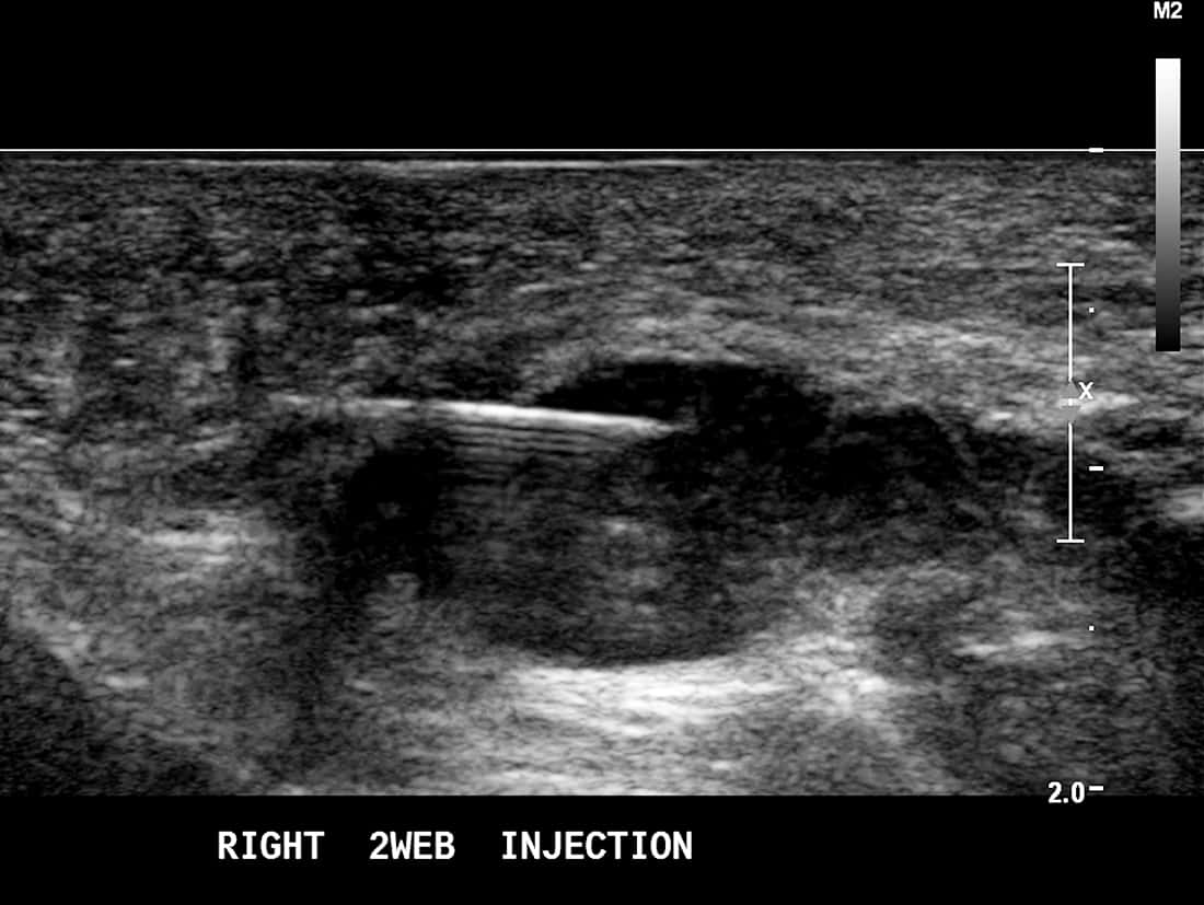 Ultrasound Guided RFA Mortons Neuroma - Melbourne Radiology Clinic Ultrasound Guided RFA Mortons Neuroma - Melbourne Radiology Clinic