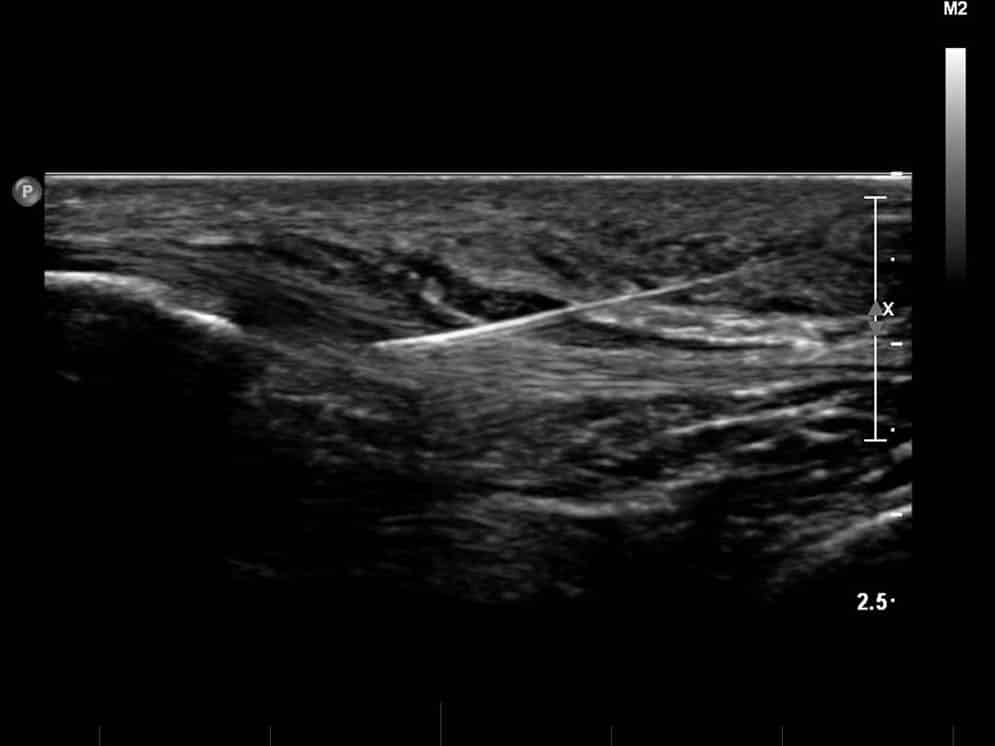 ultrasound of an injection to the patellar tendon