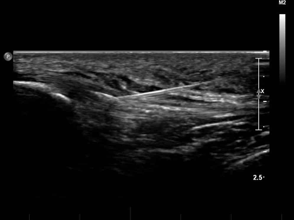 ultrasound injection in a patellar tendon