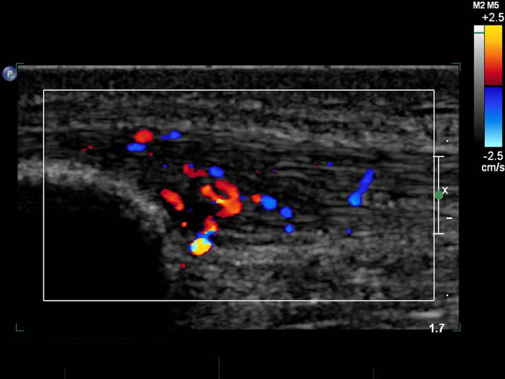 Ultrasound of patellar tendon with neovascularity