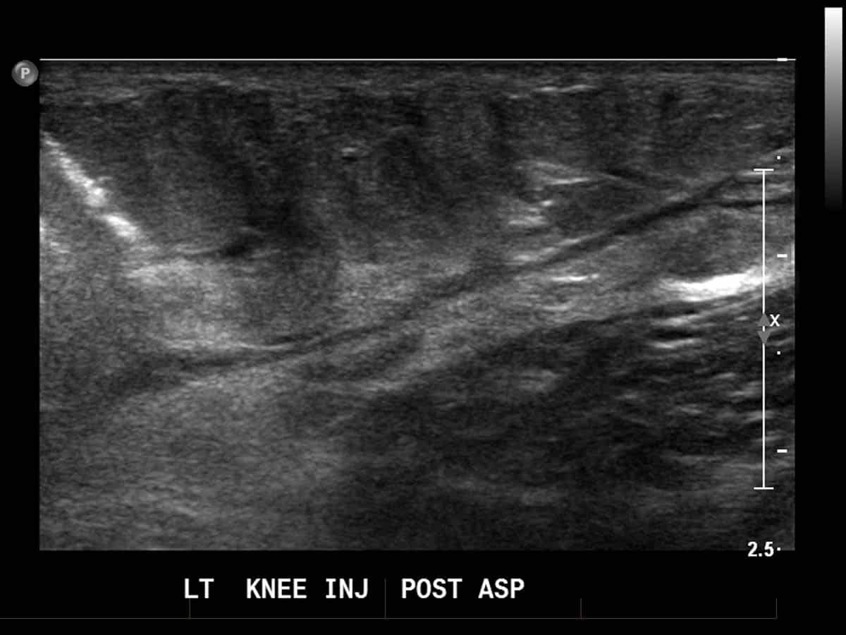 ultrasound guided knee injection