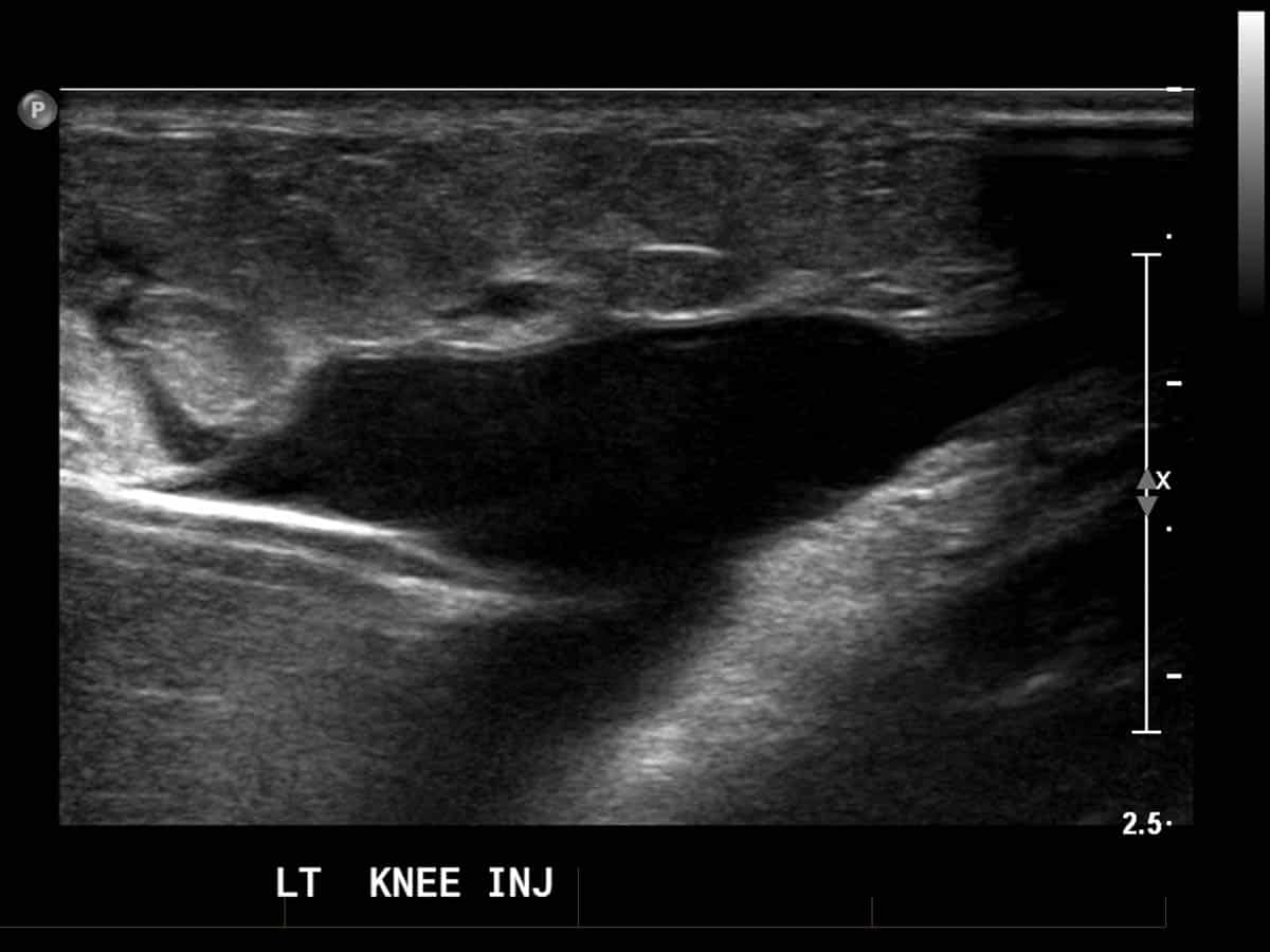 ultrasound of a knee joint injection