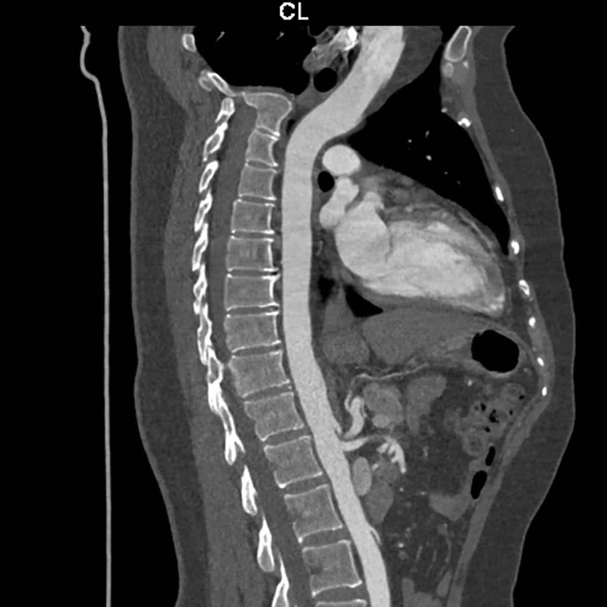 thoracic aorta angiogram CT scan