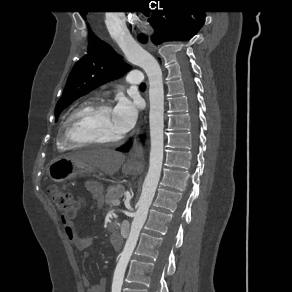 CT scan of thoracic aorta angiogram