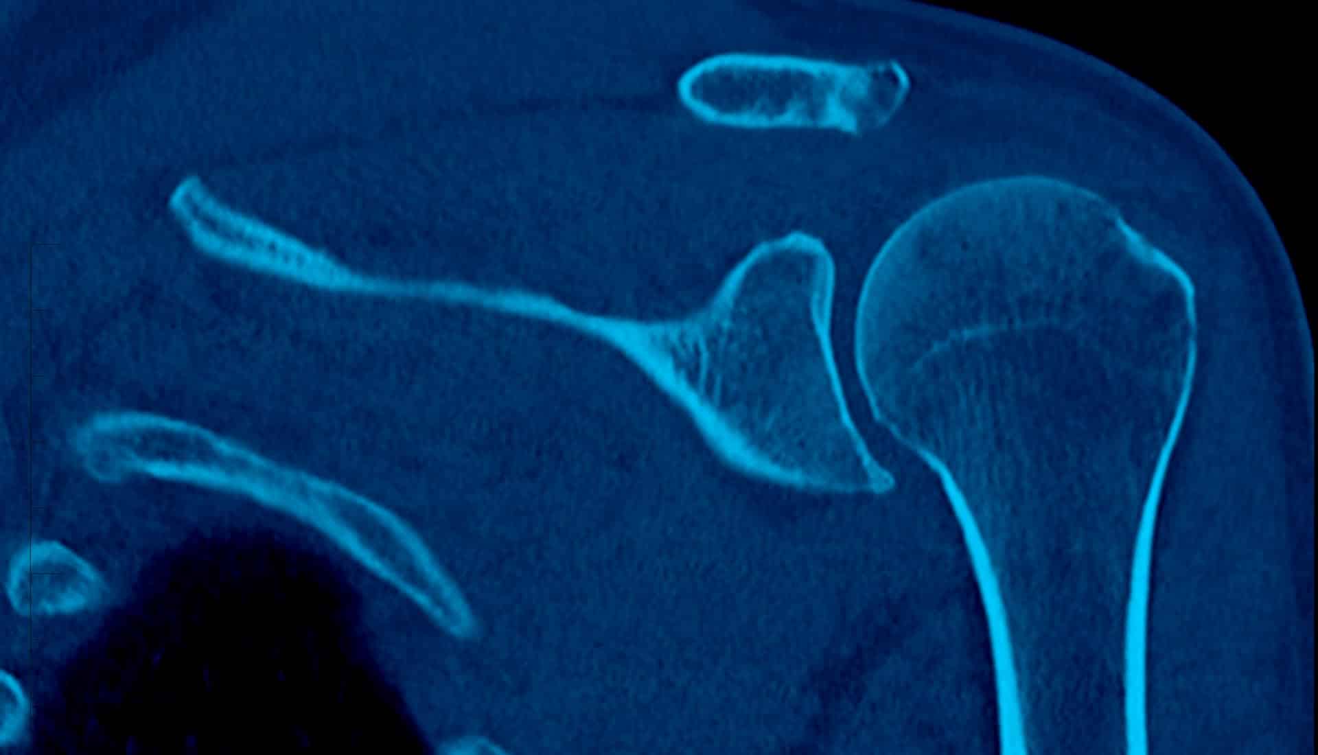 Low-dose multi-slice CT Scan- Shoulder CT
