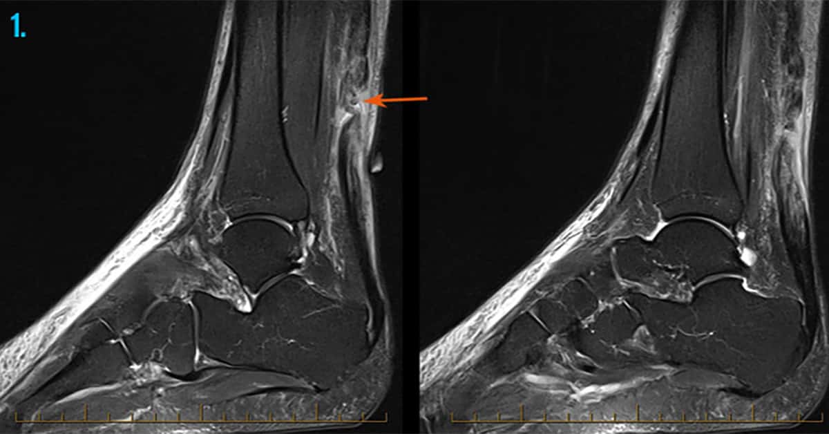 Foot Ankle Injuries Sports Imaging Melbourne Radiology