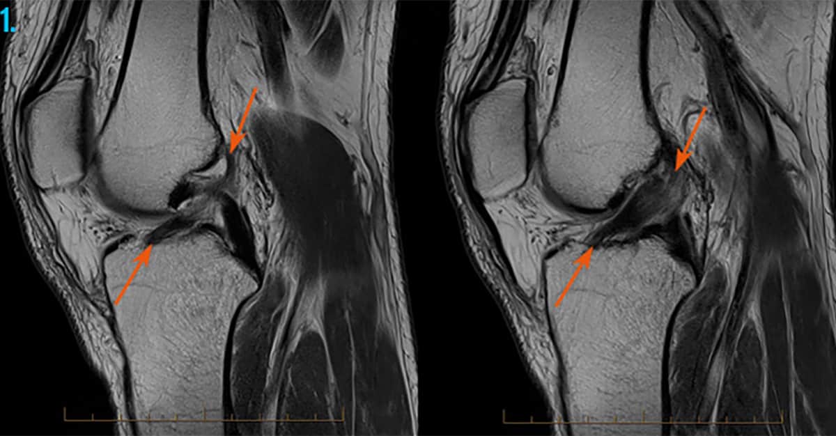 Knee Injuries Diagnostic Imaging , MRI, CT Scan Melbourne Radiology