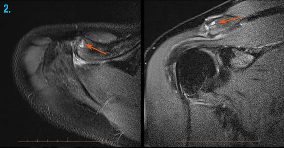 MRI & X-ray for Shoulder Injury Melbourne