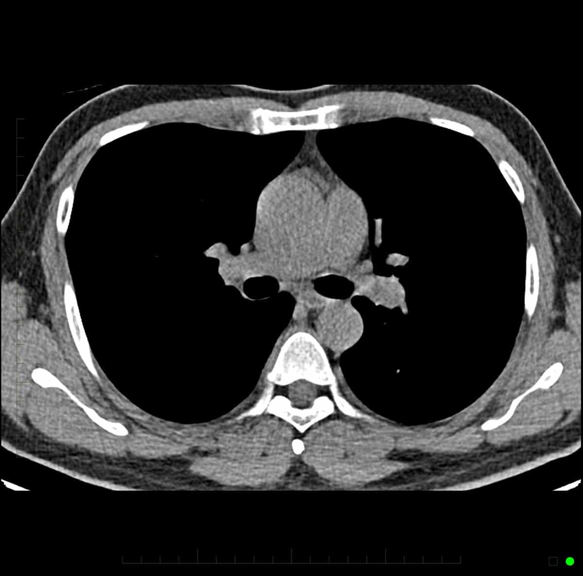 CT chest scan 1