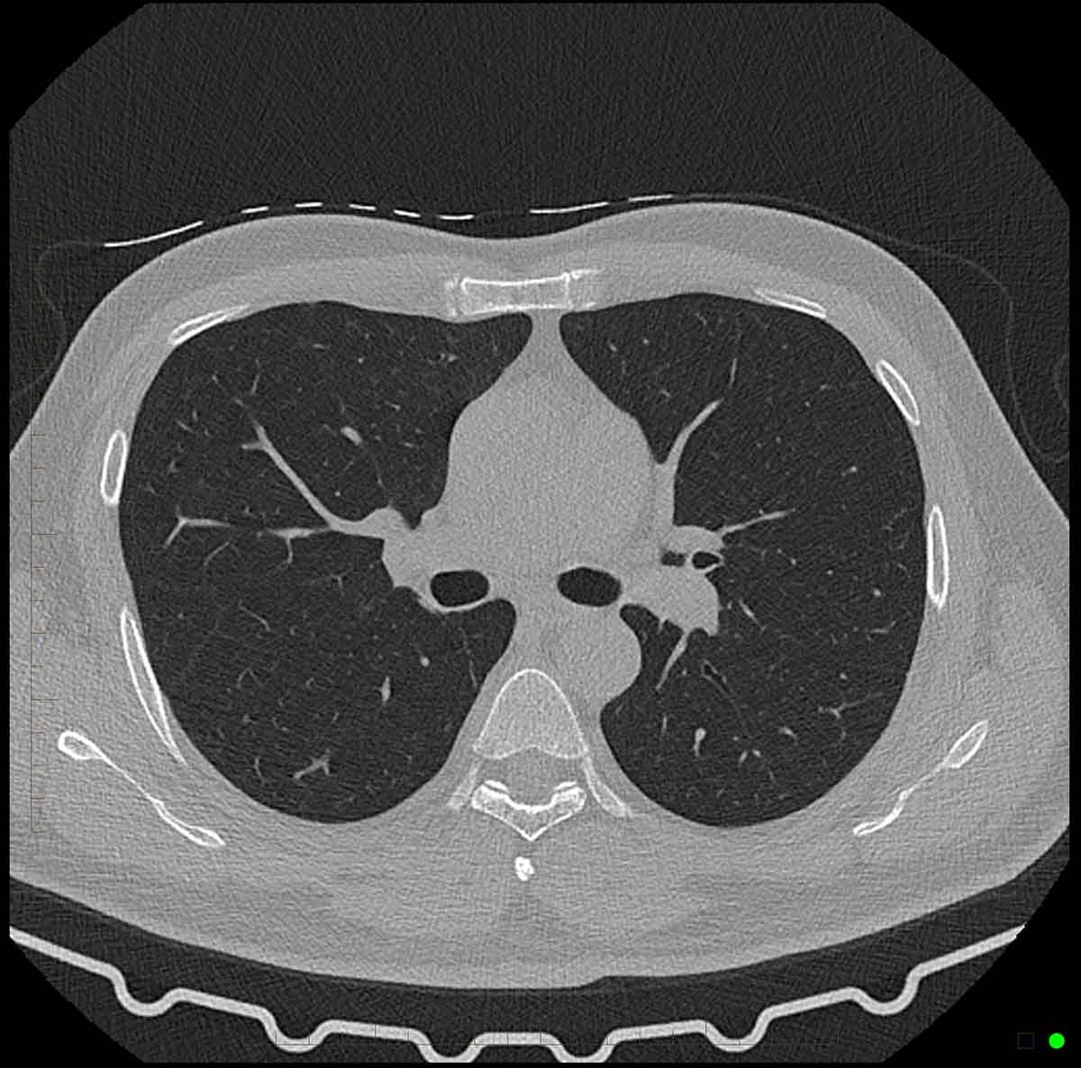 CT chest scan 2