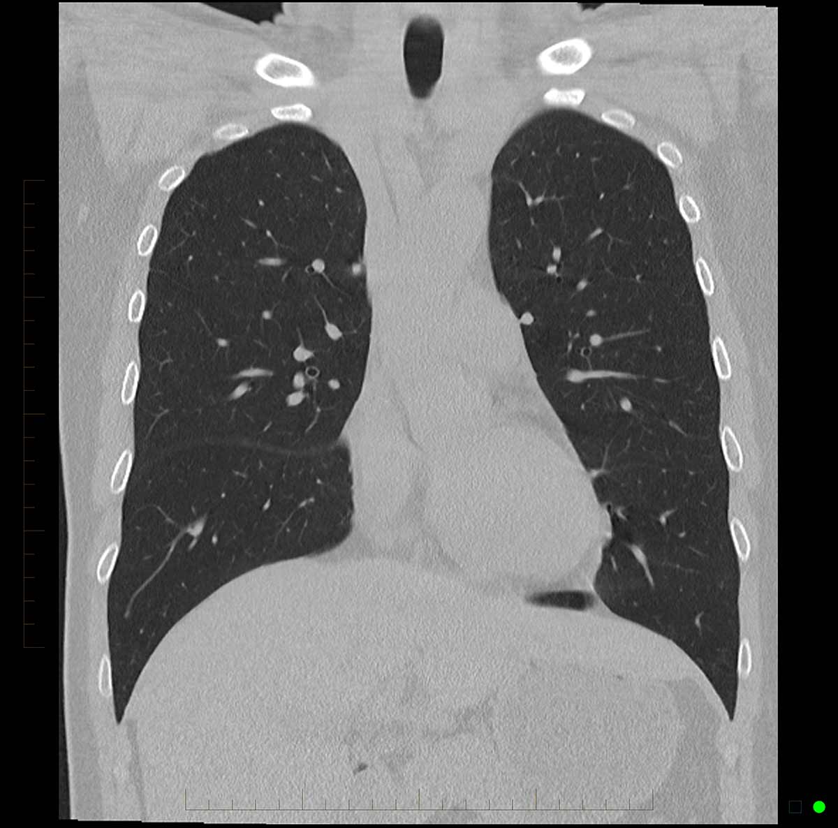 CT chest scan 3