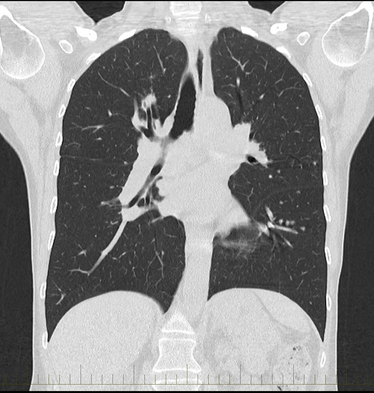 CT chest scan 4