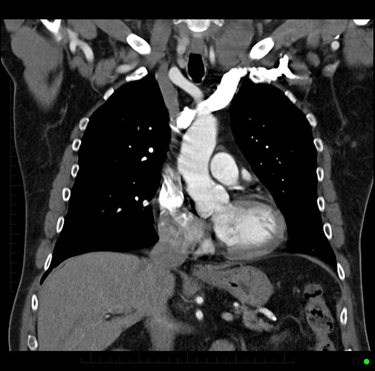 CT chest scan 5