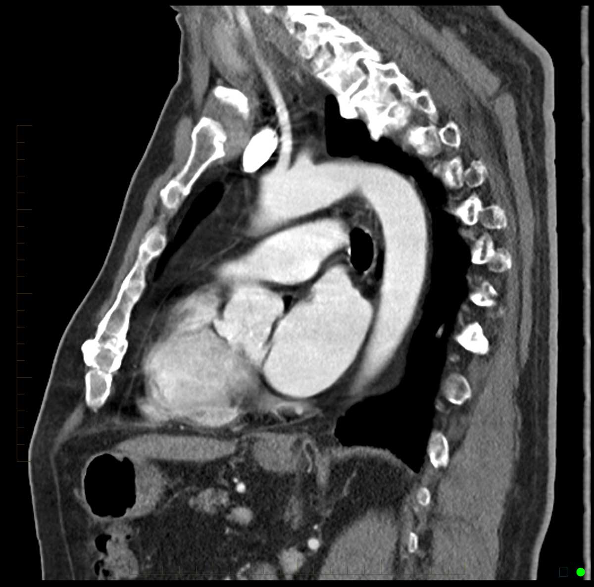 Chest Ct Scan Melbourne Radiology