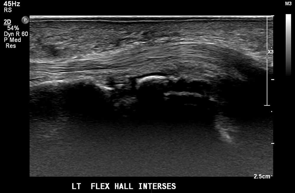 Left Foot Ultrasound Flex hall Interses - Melbourne Radiology