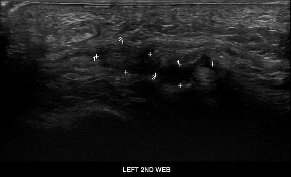 ultrasound of left foot 1