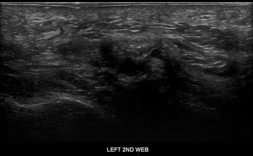 ultrasound of left foot 2