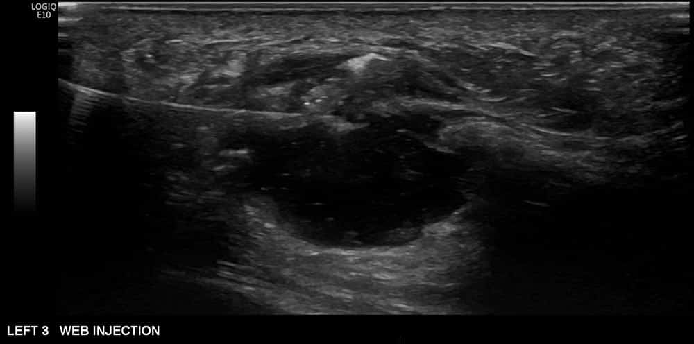 ultrasound of left foot 3