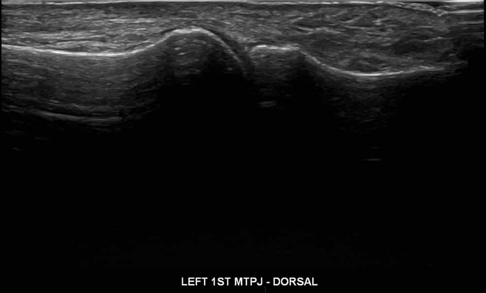 ultrasound of left foot 4