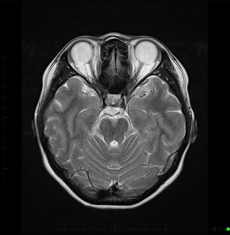 Brain Scans Mri