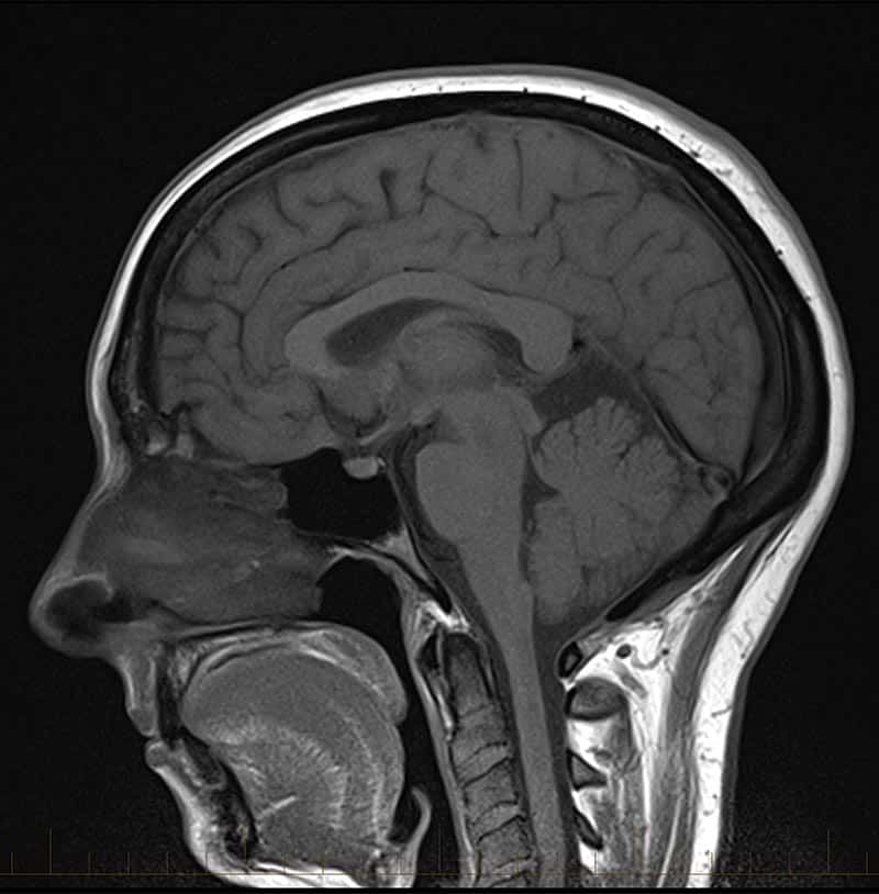 MRI brain scan with contrast 2