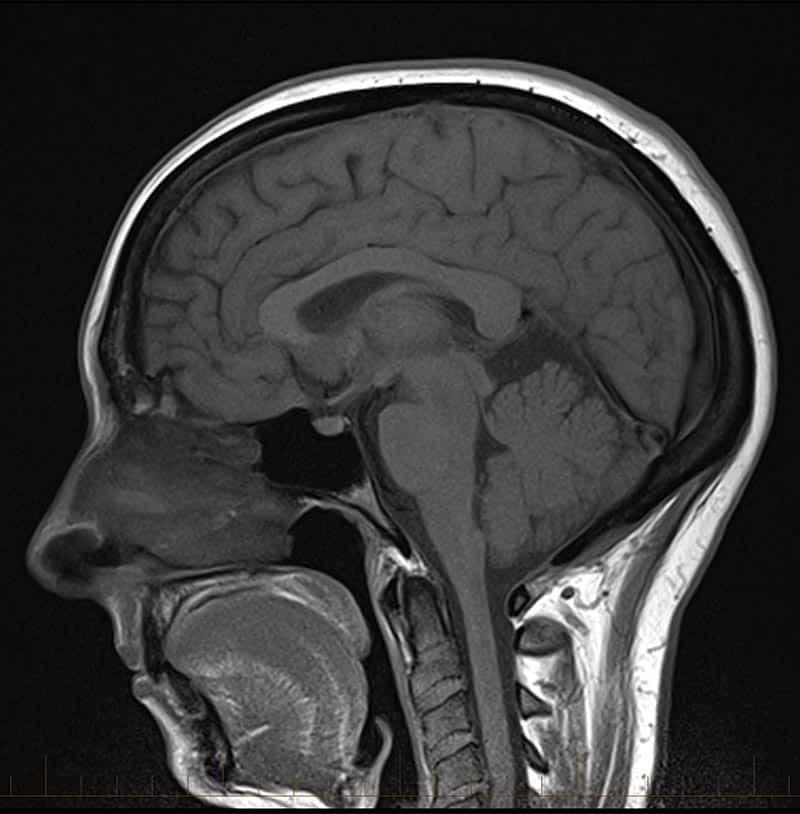 Brain Scans Mri