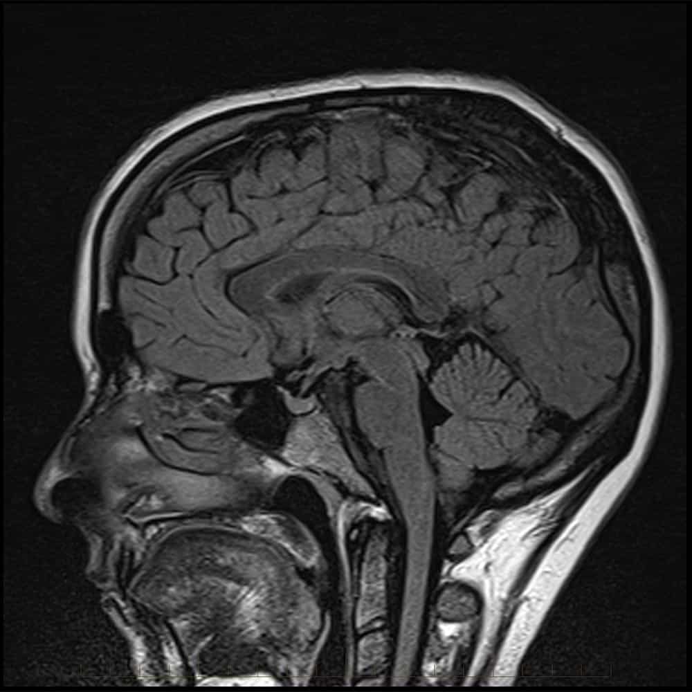 MRI brain scan with contrast 5