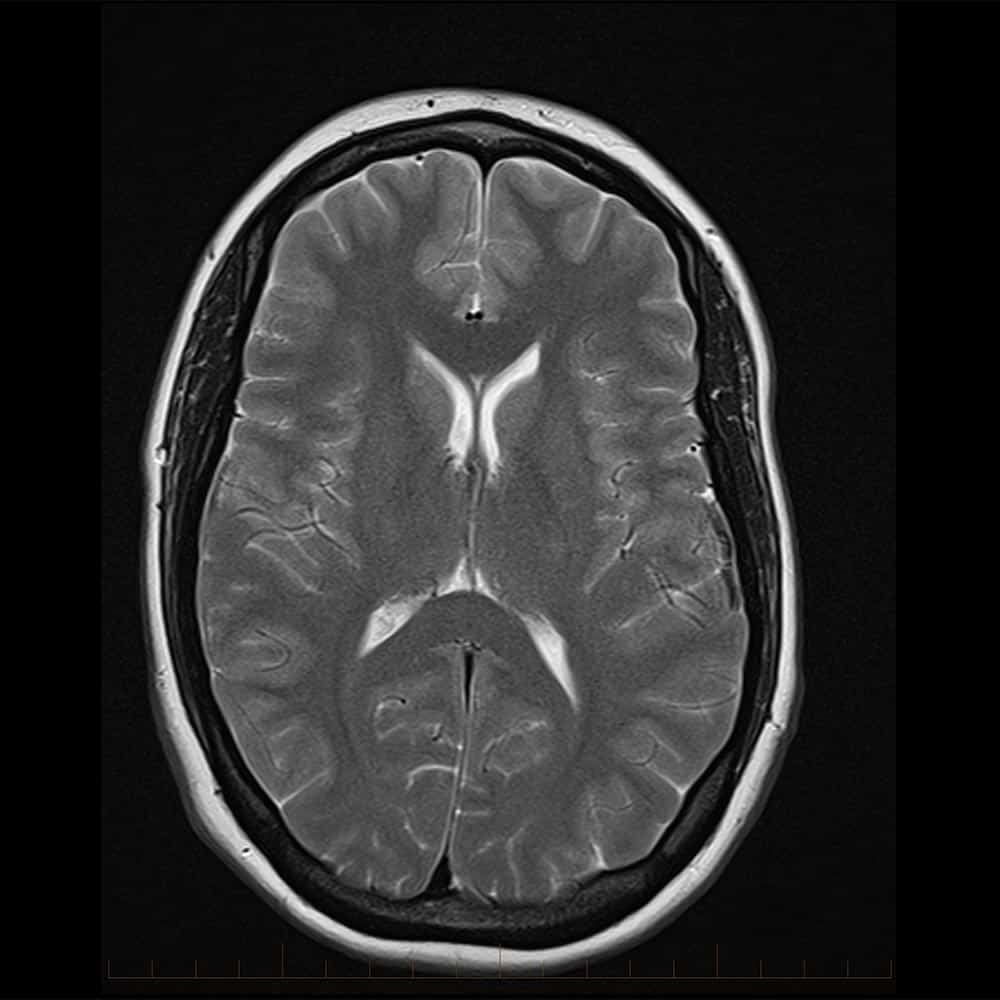 MRI brain scan with contrast 6