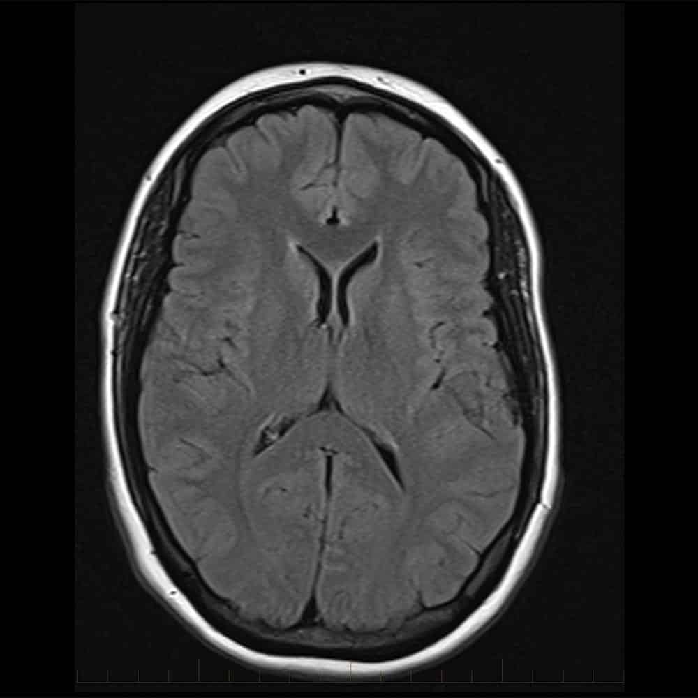 MRI brain scan with contrast 7