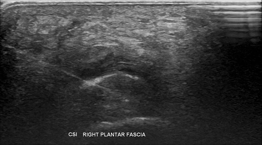 Right Plantar fascia ultrasound 1