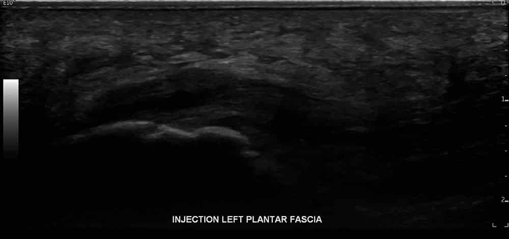 Left Plantar fascia ultrasound 1