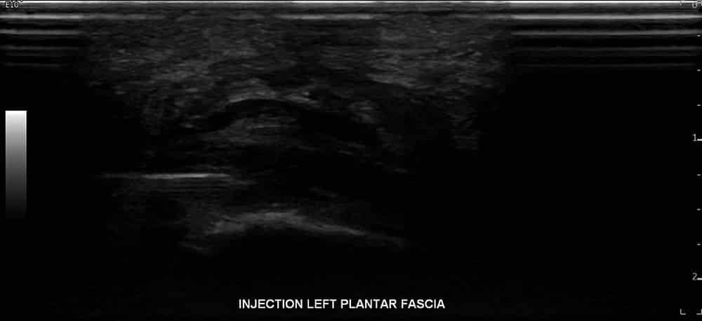 Left Plantar fascia ultrasound 2