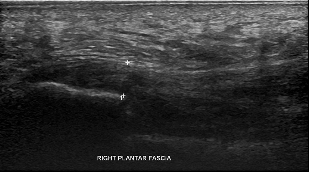 Right Plantar fascia ultrasound 2