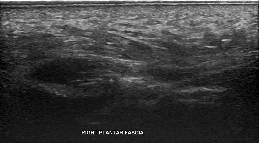 Right Plantar fascia ultrasound 3