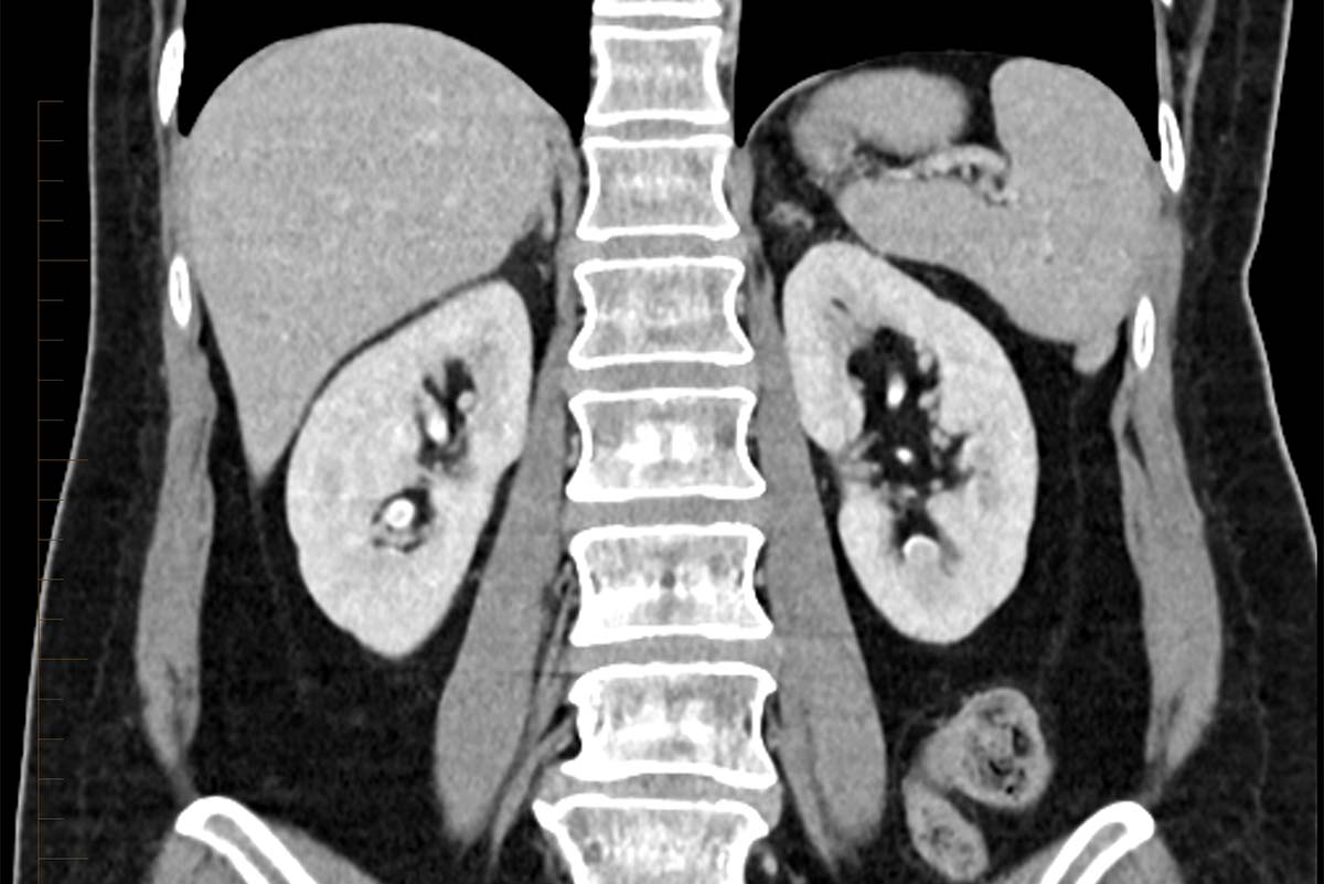 a CT scan image showing both kidneys