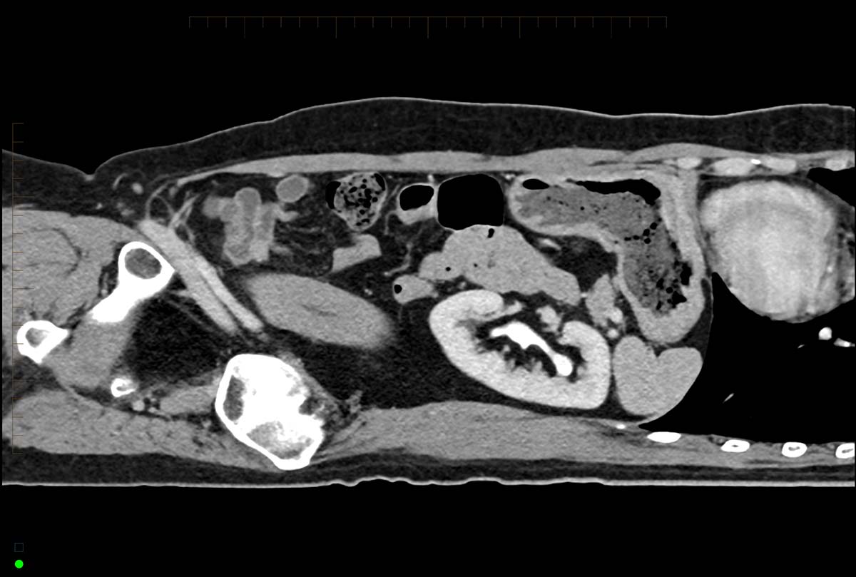kidney ct scan