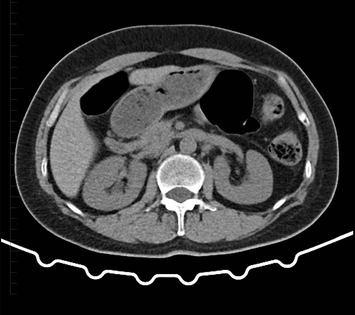 Lesion On Kidney CT Scan