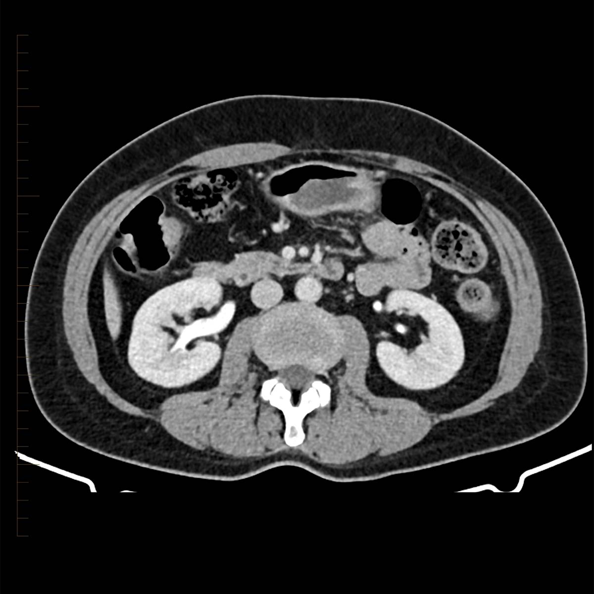 a CT scan image of a kidney