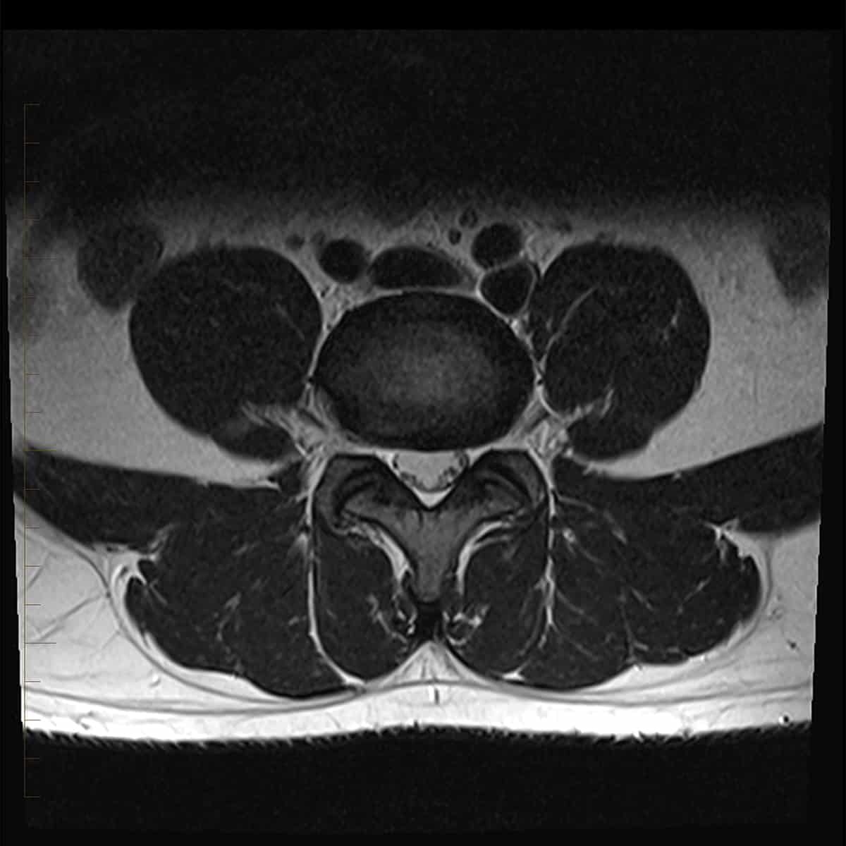Lumbar Spine MRI - Melbourne Radiology