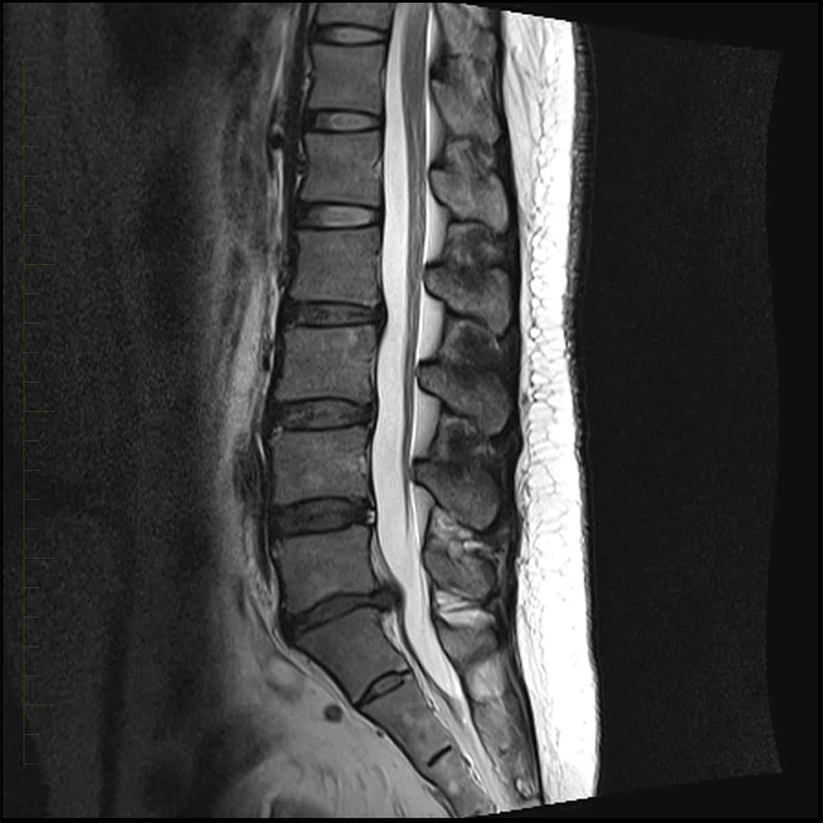 Lumbar Spine MRI 4 - Melbourne Radiology