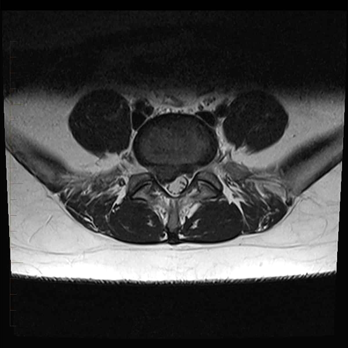 Lumbar Spine MRI 3 - Melbourne Radiology