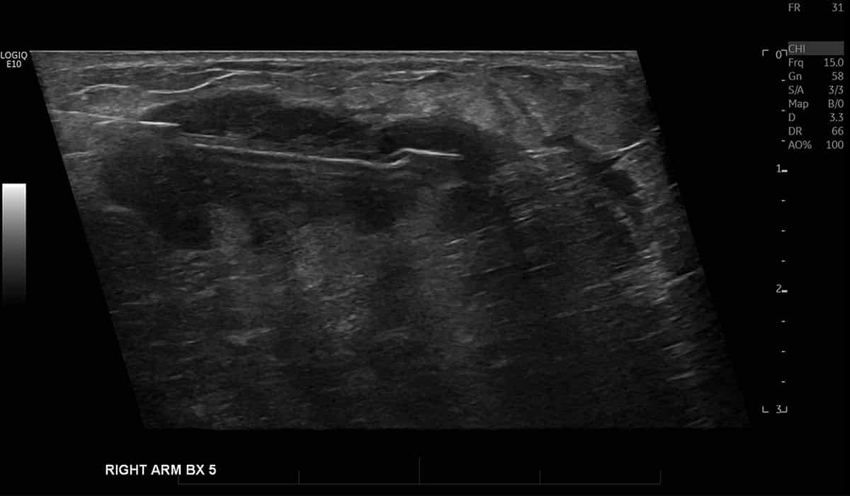 Arm Ultrasound Guided Biopsy for Tissue Diagnosis - Melbourne Radiology