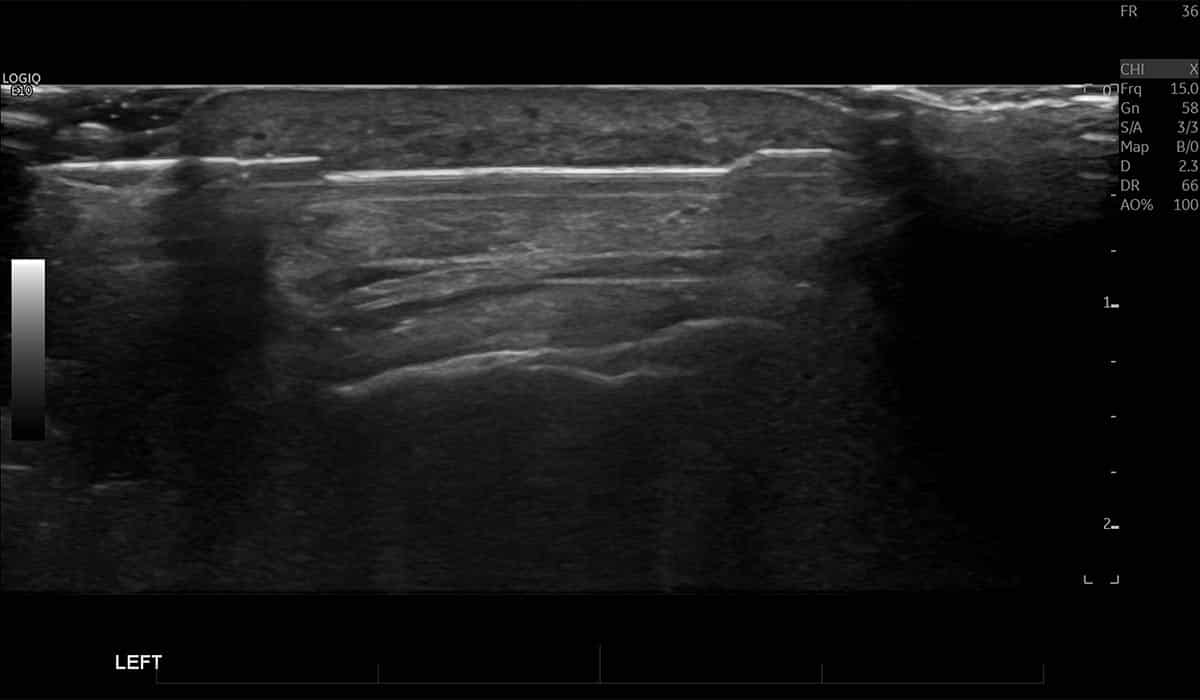Foot Ultrasound Guided Biopsy for Tissue Diagnosis - Melbourne Radiology