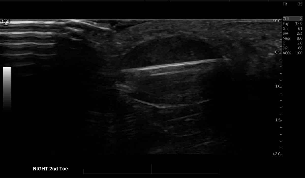 Right Toe Ultrasound Guided Biopsy for Tissue Diagnosis - Melbourne Radiology