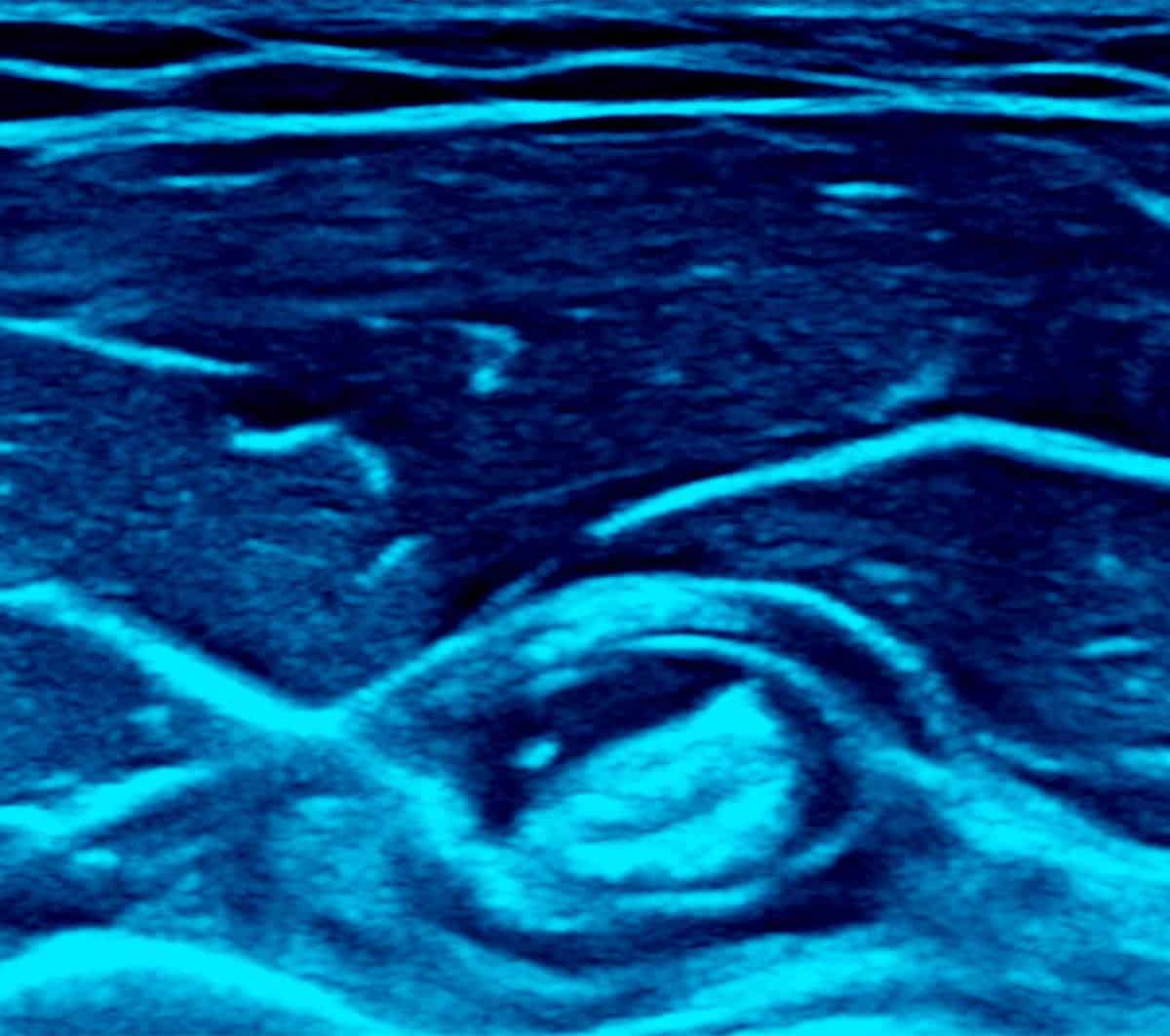 Musculoskeletal Direct Tendon Injections – Melbourne Radiology Musculoskeletal Direct Tendon Injections - Melbourne Radiology