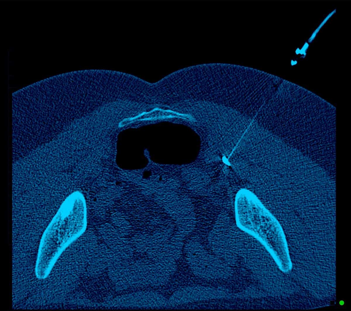 Muscle Spasticity Injection Piriformis Syndrome – Melbourne Radiology Muscle Spasticity Injection Piriformis Syndrome - Melbourne Radiology