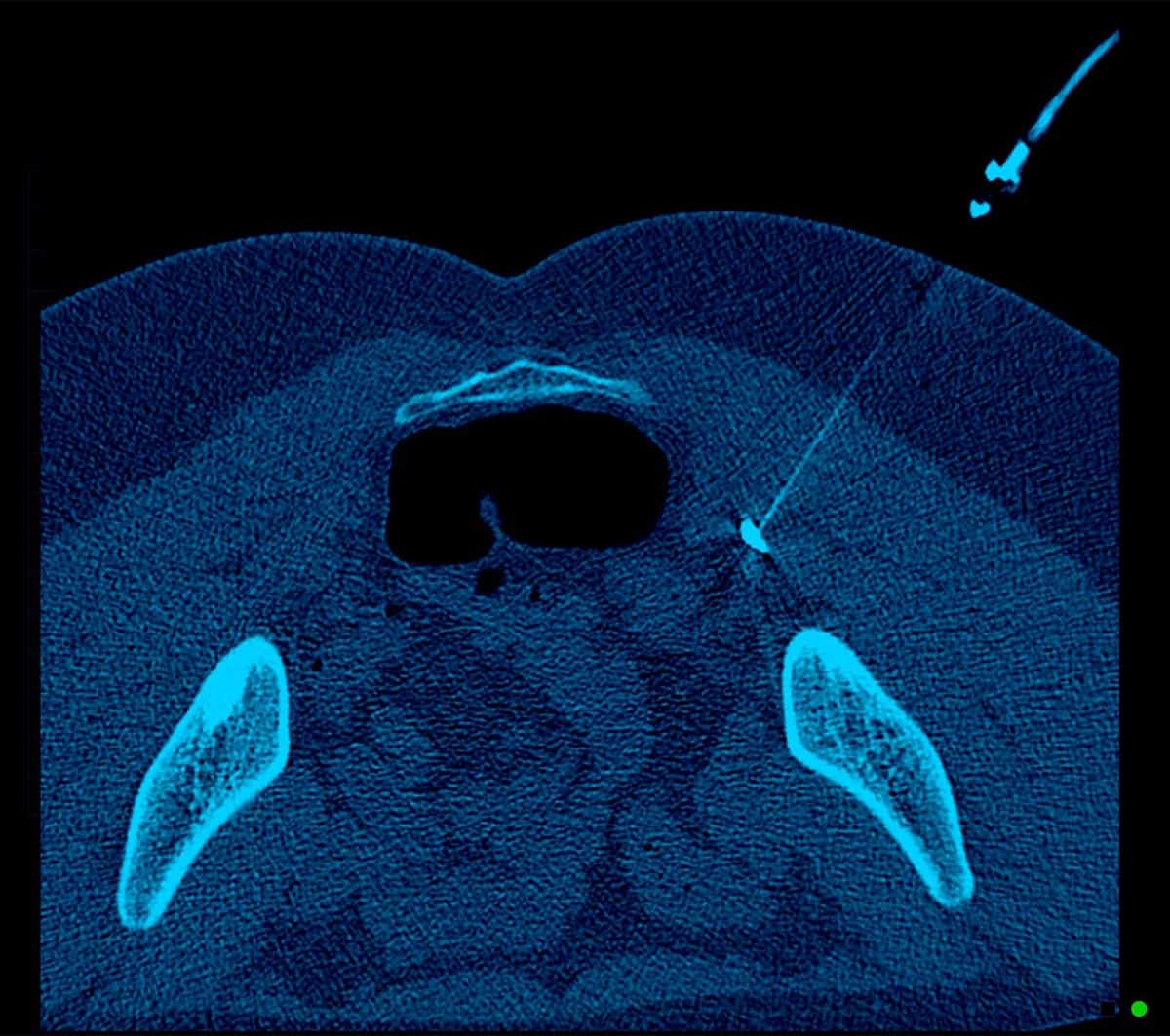 Muscle Spasticity Injection Piriformis Syndrome - Melbourne Radiology