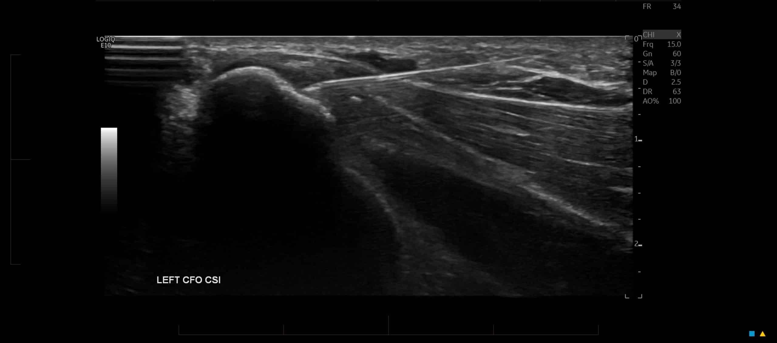 an ultrasound image of an elbow injection