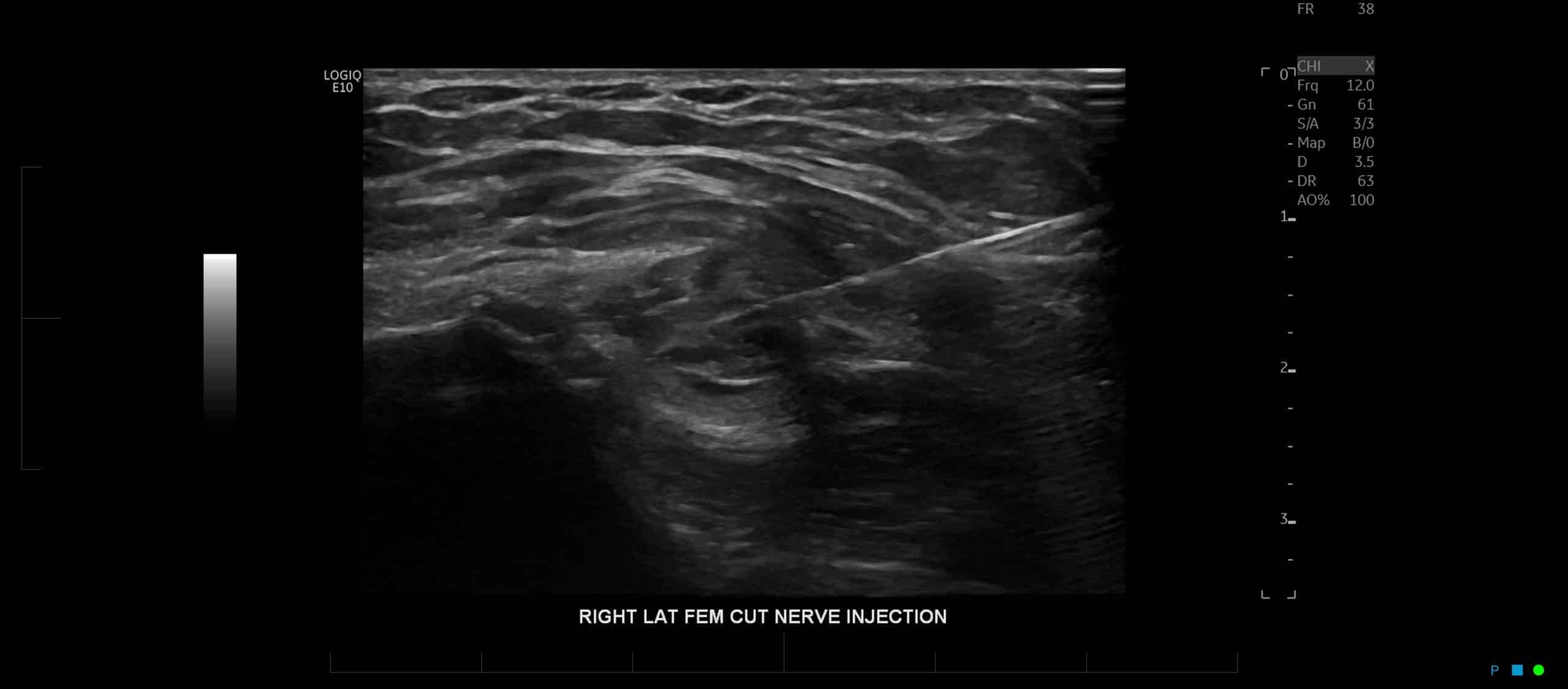an ultrasound image of right lat fem cut nerve injection
